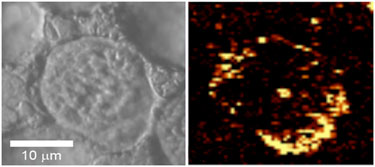 Treatment tool: carbon nanotubes inside tumor cell
