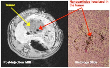 Drug-loaded polymer coated iron oxide nanoparticles