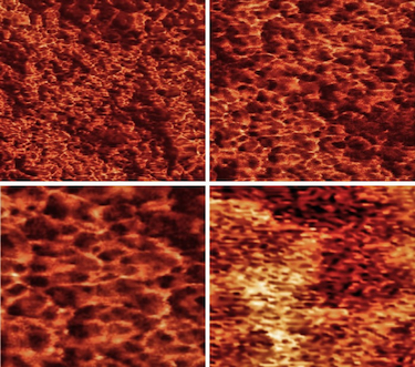 Cancer chaos: Surface patterns on human cervical epithelial cells