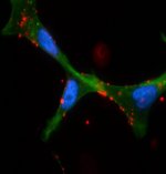 Image of three prostate cancer cells that have taken up fluorescently labelled nanoparticles (shown in red).