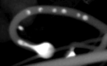 Gold bead-string in a silicon nanowire