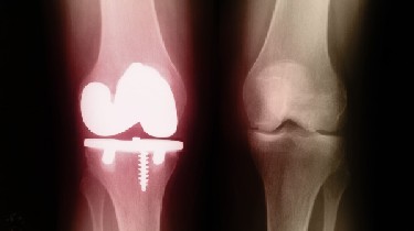 Glass bones