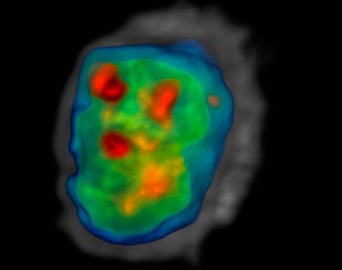 3D image of a cancer cell
