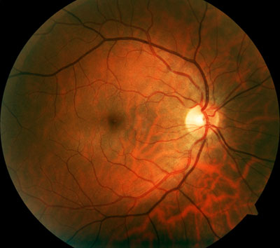 Retinal photograph of a human eye